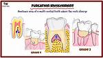 What Does Furcation Mean?