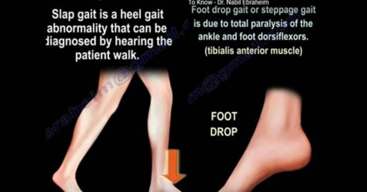 What Does High Stepping Do?