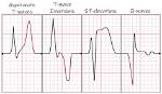 What Does Hyperacute T Waves Mean?