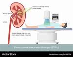 What Does Lithotripsy Mean?