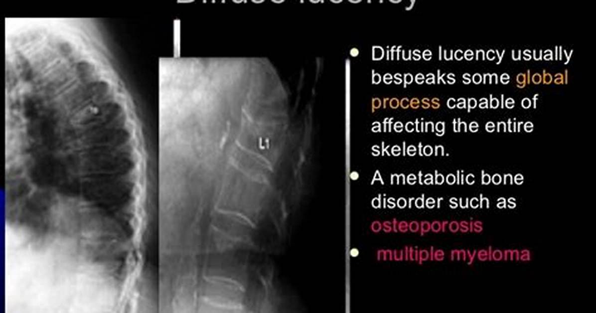 What Does Lucency Mean?
