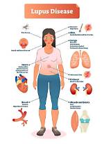 What Does Lupus Do?