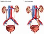What Does Megaureter Mean?