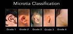 What Does Microtia Mean?