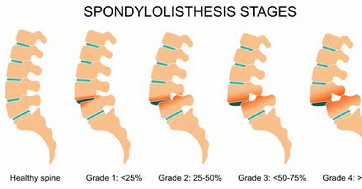 What Does No Listhesis Mean