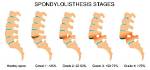 What Does No Listhesis Mean