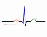 What Does P Wave Represent