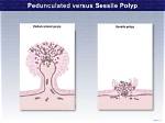 What Does Pedunculated Mean?