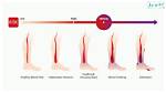 What Does Phlebostasis Do?