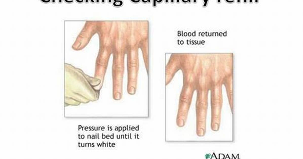 What Does Poor Capillary Refill Indicate