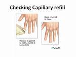 What Does Poor Capillary Refill Indicate