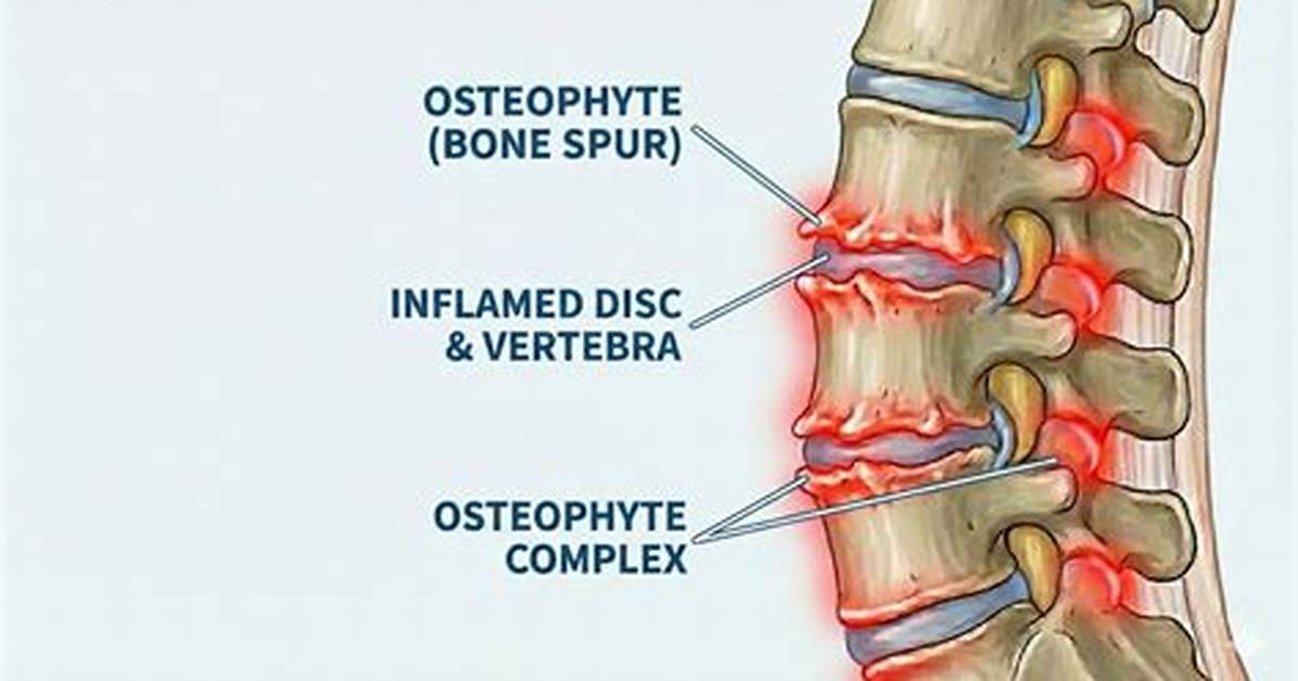 What Does Posterior Disc Osteophyte Complex Mean? Check This out | Broad Based Posterior Disc Osteophyte Complex