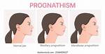 What Does Prognathism Mean?