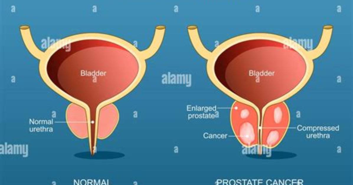 What Does Prostate Mean?