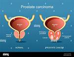 What Does Prostate Mean?