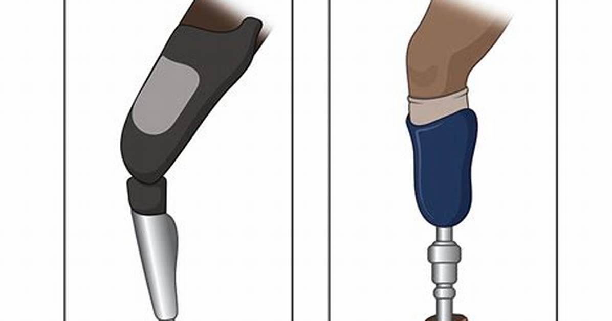 What Does Prosthesis Mean?