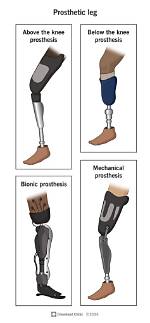 What Does Prosthesis Mean?