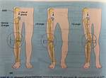 What Does Q Angle Stand For