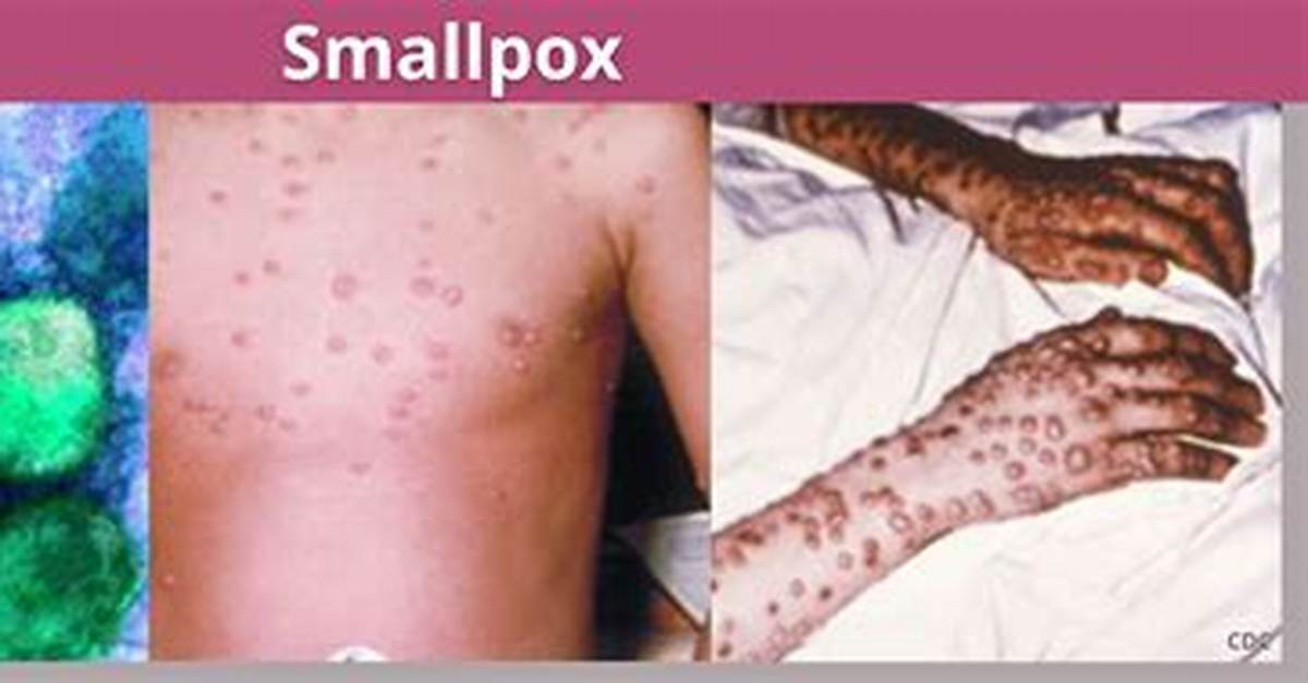 What Does Smallpox Look Like