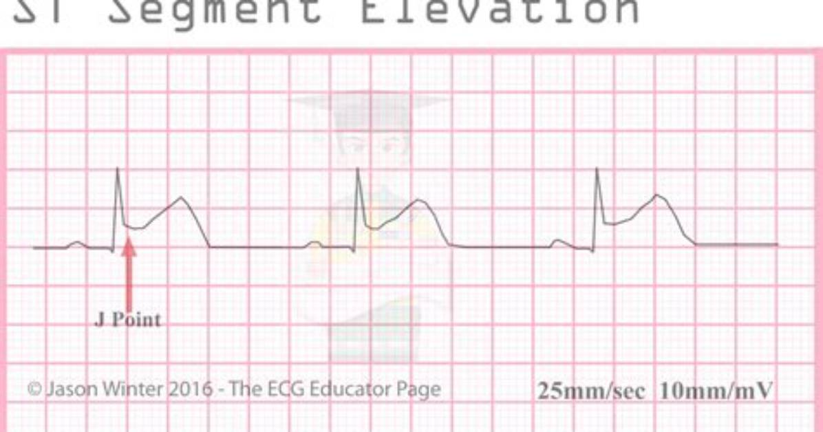 What Does St Segment Mean