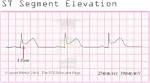 What Does St Segment Mean