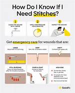 What Does Stitches Mean?