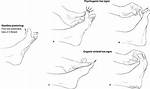 What Does Striatal Toe Mean?