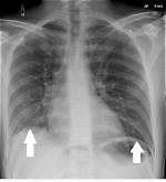 What Does Subphrenic Mean Medically?
