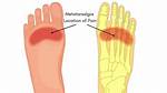 What Does Tarsalgia Mean?