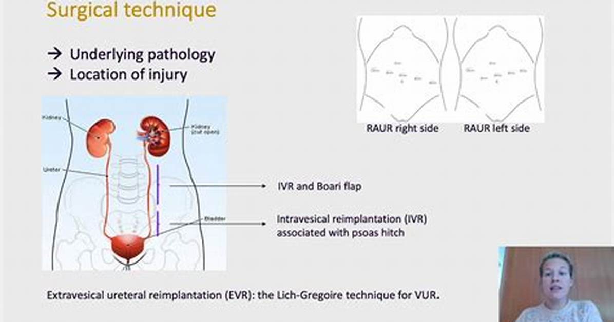 What Does Urethrectomy Mean?