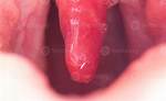 What Does Uvulitis Look Like?