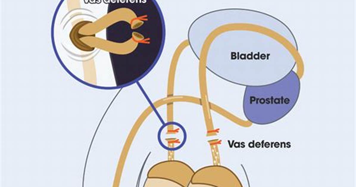 What Does Vasectomy Do?