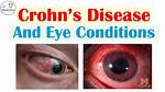 What Eye Problems Are Associated with Crohns Disease