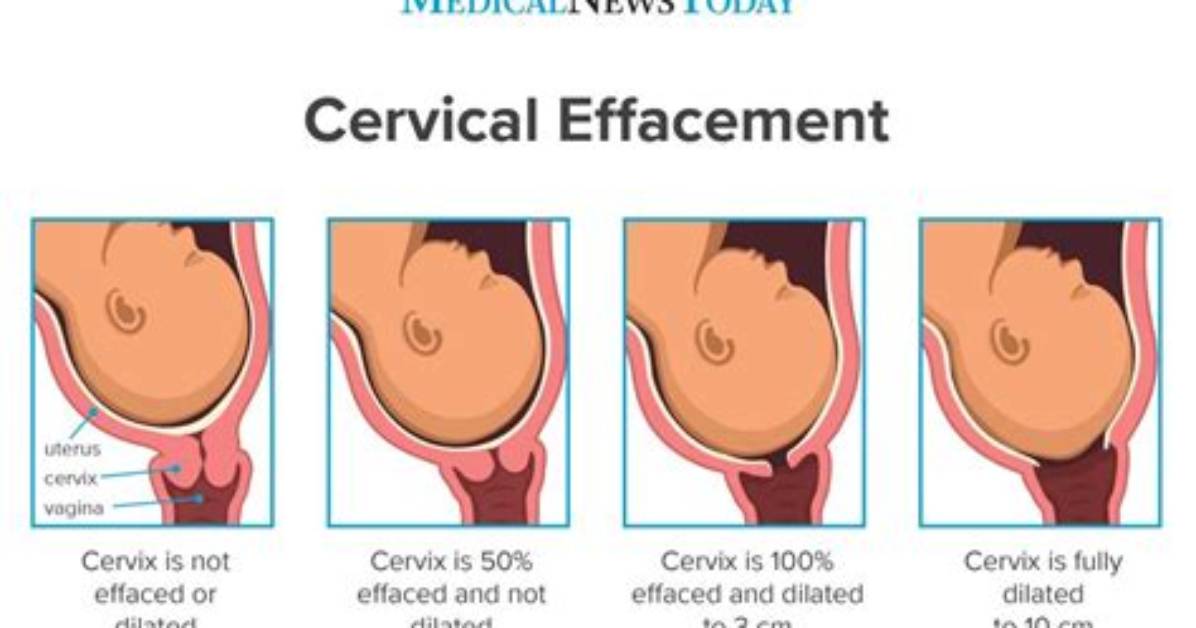 What Helps Effacement?