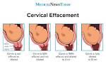 What Helps Effacement?