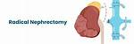 What Is a Nephrectomy?