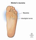 What Is a Neuroma and How Is It Treated?