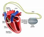 What Is a Pacemaker Called?