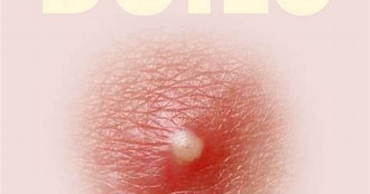 What Is a Risen Bump?