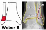 What Is a Weber B Fracture of the Ankle?