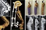 What Is Angular Kyphosis