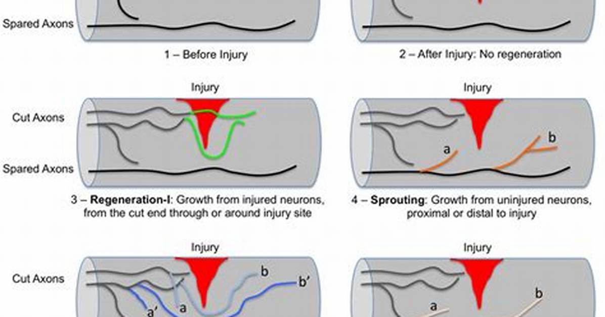 What Is Axonal Sprouting