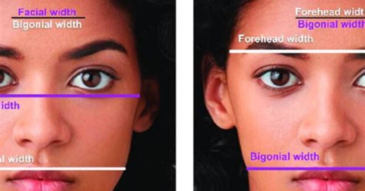 What Is Bigonial Width?