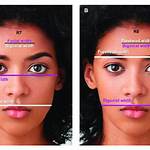 What Is Bigonial Width?