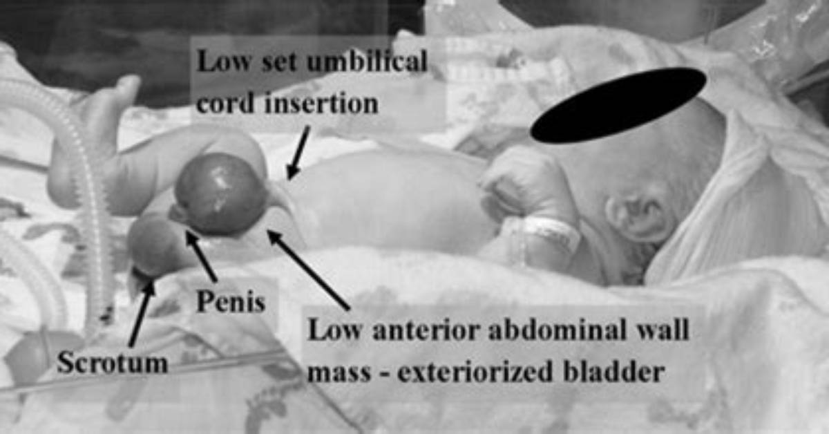 What Is Bladder Exstrophy