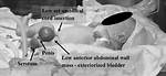 What Is Bladder Exstrophy