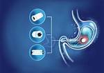 What Is Camera Endoscopy? - inSite Digestive Health Care