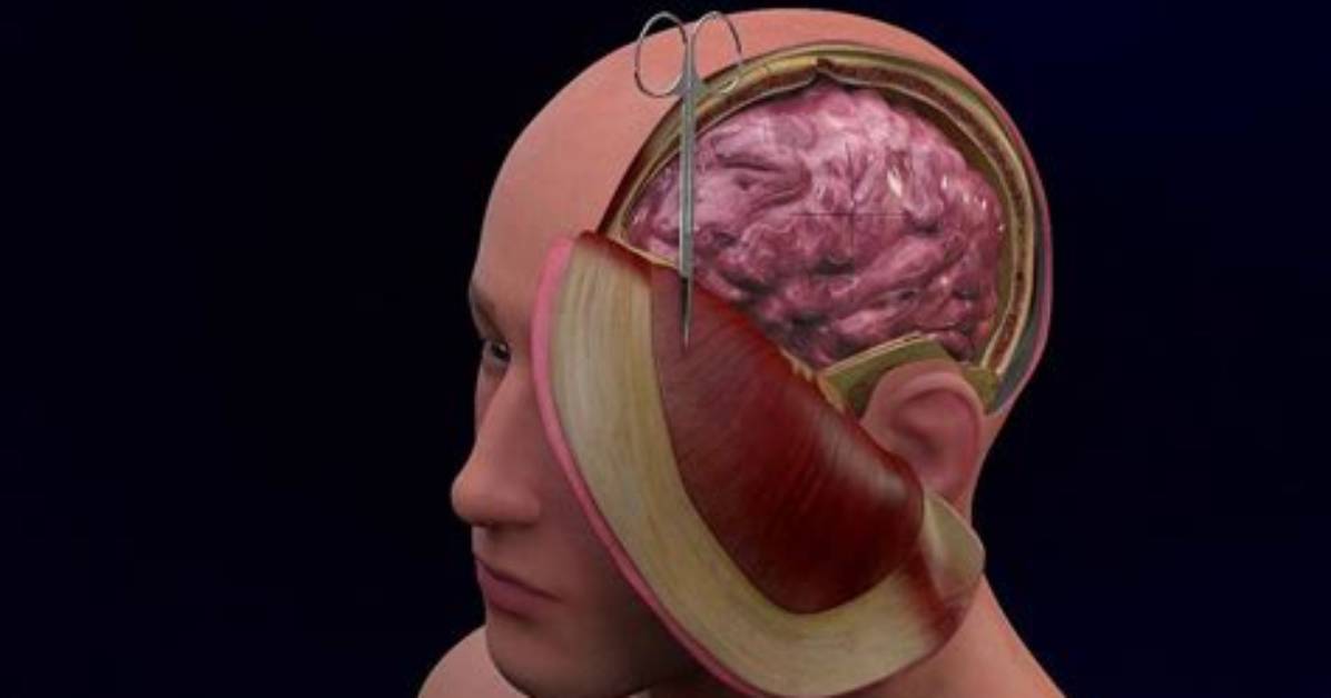 What Is Decompressive Surgery?