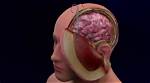 What Is Decompressive Surgery?