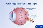 What Is Elevated Iop